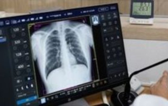 Σύστημα τεχνητής νοημοσύνης μπορεί να διαγνώσει έως και 1 χρόνο πριν καρκίνο των πνευμόνων