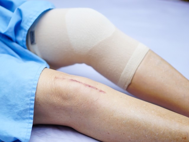 Metropolitan: Nεότερα δεδομένα και οφέλη από την αρθροπλαστική