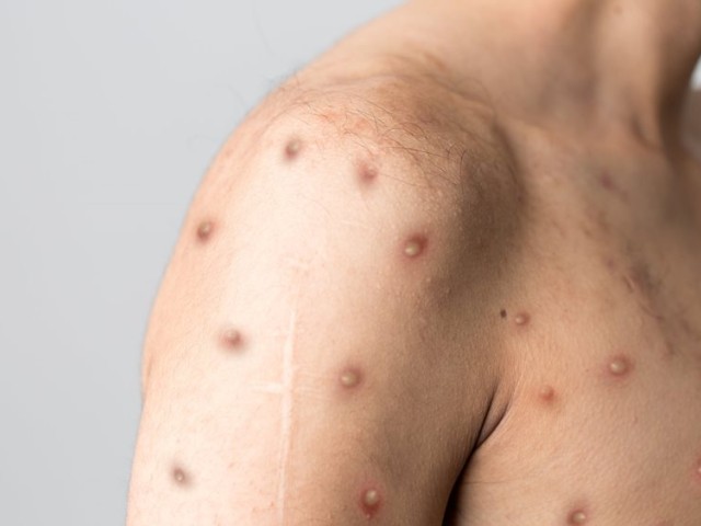 Μπορεί η ευλογιά των πιθήκων να εξελιχθεί σε νέα πανδημία;