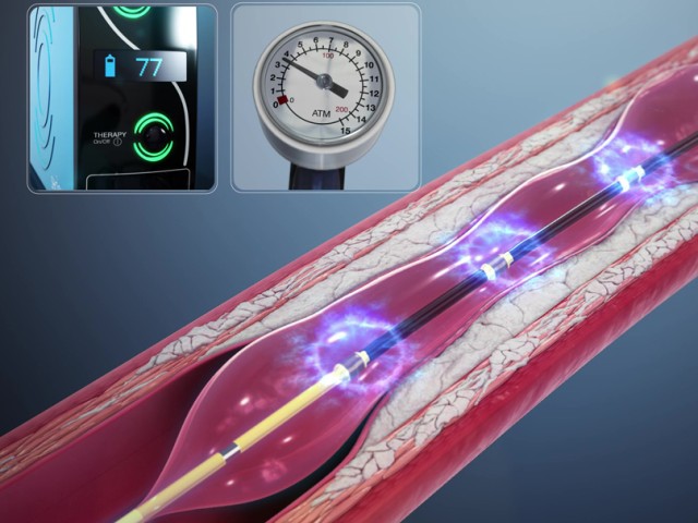 Ενδοστεφανιαία λιθοτριψία: Σύγχρονη αντιμετώπιση στεφανιαίων βλαβών