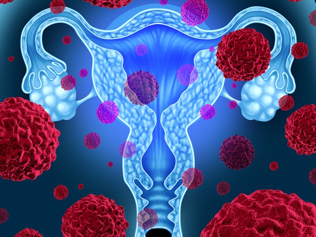 Καρκίνος του ενδομητρίου: Τα νεότερα δεδομένα για τη θεραπεία