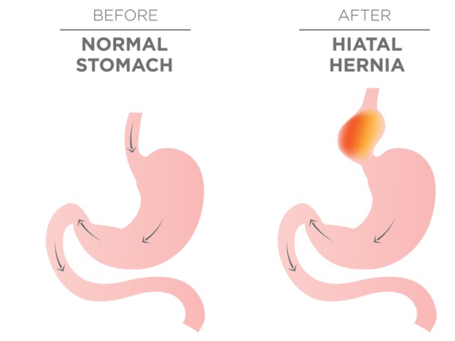 Αντιμετώπιση της διαφραγματοκήλης με ρομποτική χειρουργική