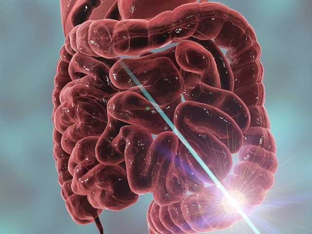 Καρκίνος παχέος εντέρου και ορθού: Οι σύγχρονες θεραπείες