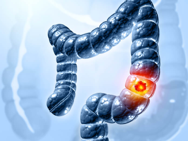 Καρκίνος του παχέος εντέρου: Ποια συμπτώματα προειδοποιούν;